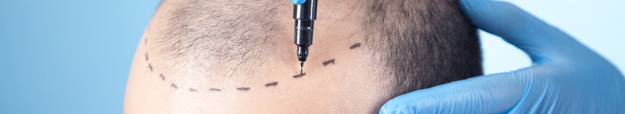 FUE Hair Transplant